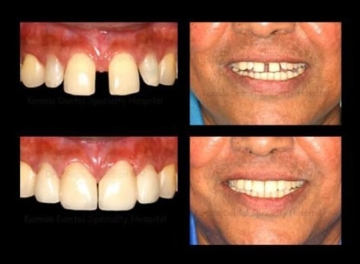 A Confident Younger Smile in a week time !!!