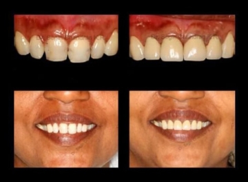 Anterior Teeth Correction in a Week