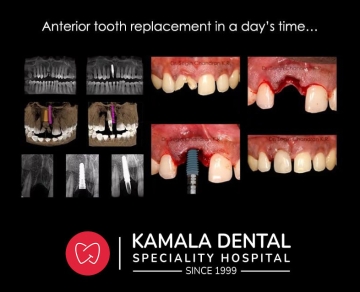Anterior Tooth Replacement in a day’s time