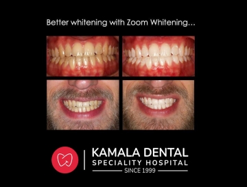 Better whitening with ZOOM Whitening