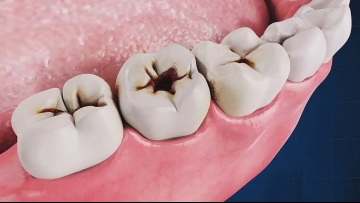 Cavities Decoded: What Causes Them, and Why Regular Check-ups Matter