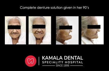 Complete denture solution given in her 90’s