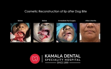 Cosmetic Reconstruction of Lip after Dog Bite