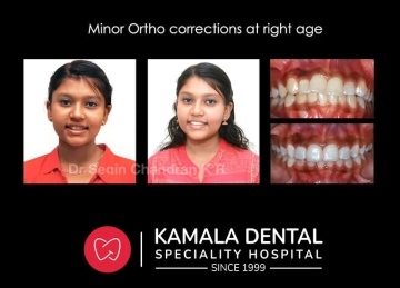 Crooked Teeth – Solution for Lifetime