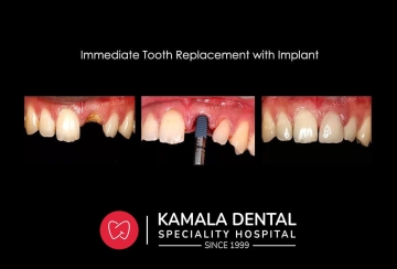 Dental Implants – Best way to get teeth replaced