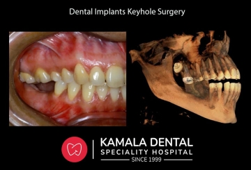 Dental Implants Keyhole Surgery