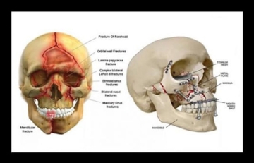 Facial Fractures