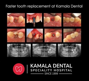 Faster Tooth Replacement At Kamala Dental