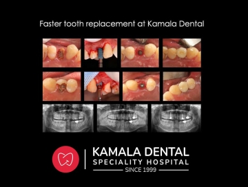 Fibrolipoma removed from lower lip