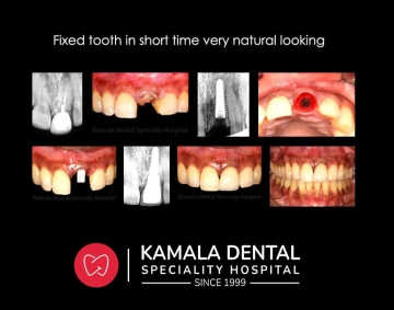 Fixed tooth in short time very natural looking