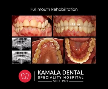 Full Mouth Rehabilitation