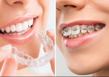 Getting them straight: Braces or Clear Aligners?