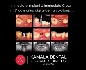Immediate Implant & Immediate Crown in ‘5’ days using digital dental solutions