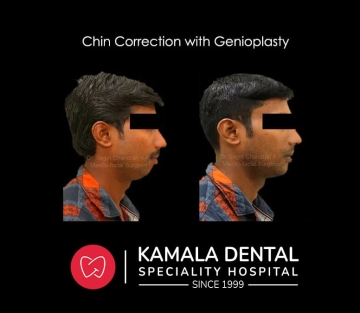 Jaw Correction with Genioplasty