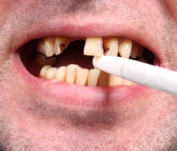 Lighting Up? Here’s What Smoking Does to Your Teeth – Straight from Trivandrum’s Dental Experts.
