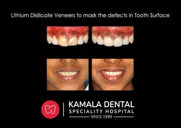 Lithium Disilicate Veneers to mask the defects in tooth surface