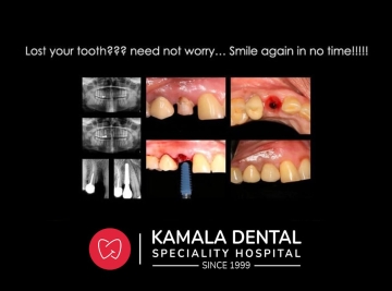 Lost your tooth??? Need not worry…Smile again in no time!!!!!