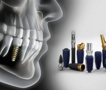 Missing Teeth? Here’s Your Complete Guide to Dental Implants