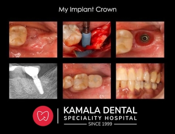 My Implant Crown
