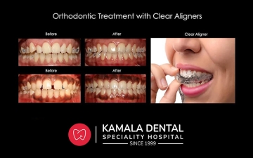 Orthodontic Treatment with Clear Aligners