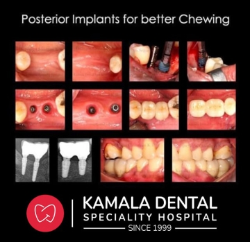 Posterior Implants for better Chewing