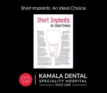 Short Implants: An Ideal Choice