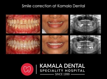 Smile Correction at Kamala Dental Thiruvananthapuram Kerala India