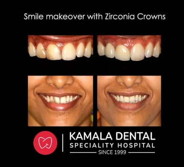 Smile Makeover with Zirconia crowns