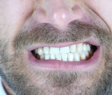 The Truth About Teeth Grinding: Causes, Treatments & How We Help You at Kamala Dental Hospital
