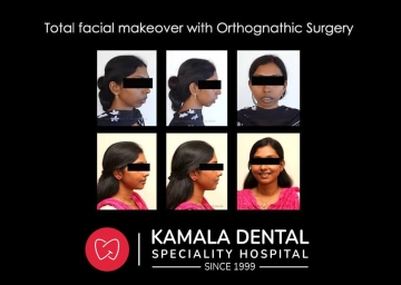 Total facial makeover with orthognathic surgery